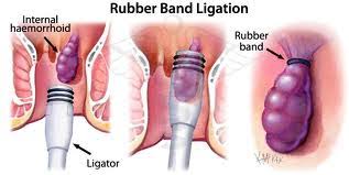 Rubber Band Ligation Procedure